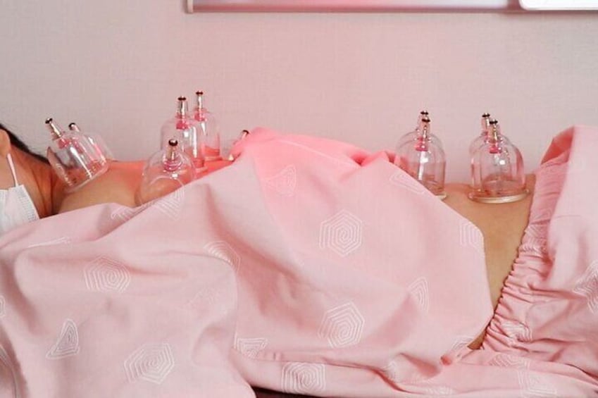 cupping therapy